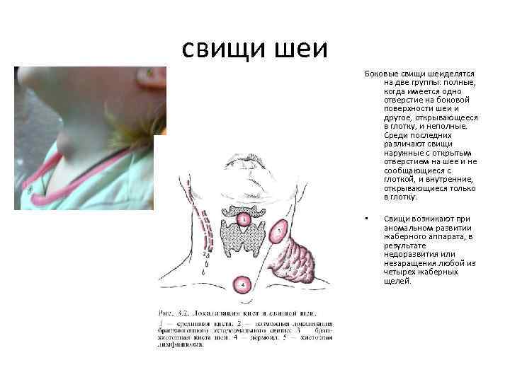 свищи шеи Боковые свищи шеиделятся на две группы: полные, когда имеется одно отверстие на