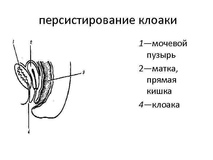  персистирование клоаки 1—мочевой пузырь 2—матка, прямая кишка 4—клоака 