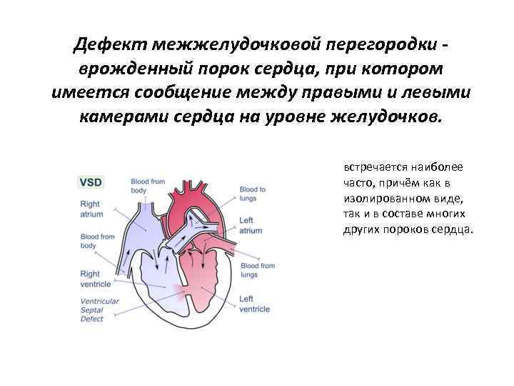 Дефект межжелудочковой перегородки врожденный порок сердца, при котором имеется сообщение между правыми и левыми