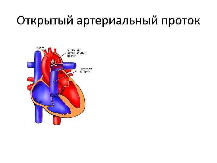 Открытый артериальный проток 