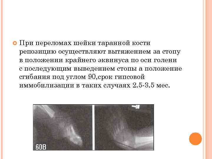  При переломах шейки таранной кости репозицию осуществляют вытяжением за стопу в положении крайнего