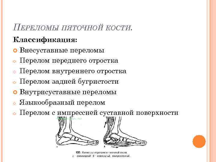 Перелом пяточной кости карта вызова