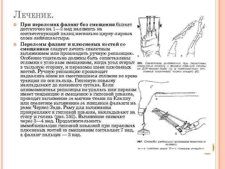 ЛЕЧЕНИЕ. При переломах фаланг без смещения бывает достаточно на 1— 2 нед наложить на