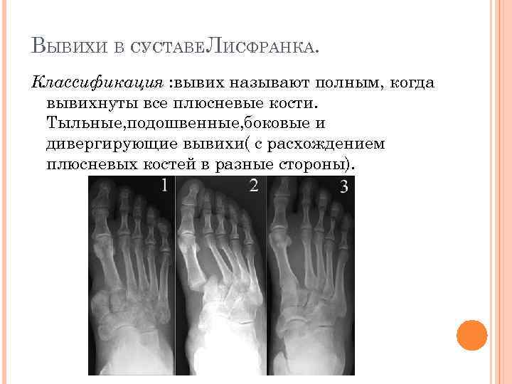 ВЫВИХИ В СУСТАВЕЛИСФРАНКА. Классификация : вывих называют полным, когда вывихнуты все плюсневые кости. Тыльные,