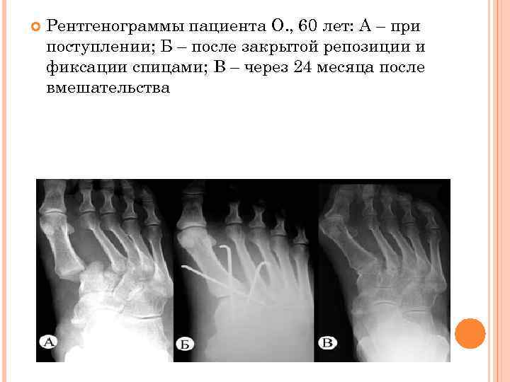  Рентгенограммы пациента О. , 60 лет: А – при поступлении; Б – после