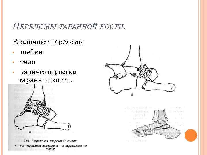 Классификация переломов пяточной кости. Изолированные переломы заднего отростка таранной кости. Переломы таранной кости классификация.