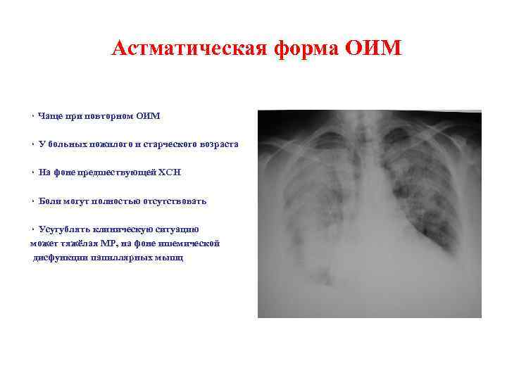  Астматическая форма ОИМ ۰ Чаще при повторном ОИМ ۰ У больных пожилого и