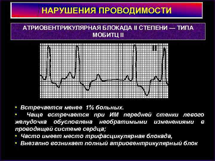 НАРУШЕНИЯ ПРОВОДИМОСТИ АТРИОВЕНТРИКУЛЯРНАЯ БЛОКАДА II СТЕПЕНИ — ТИПА МОБИТЦ II • Встречается менее 1%