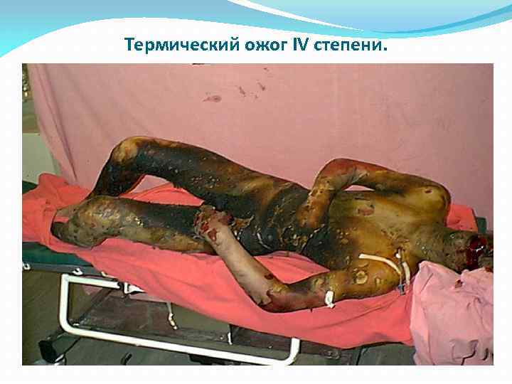 Термический ожог IV степени. 