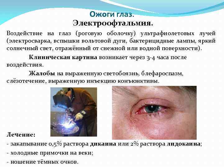Ожоги глаз. Электроофтальмия. Воздействие на глаз (роговую оболочку) ультрафиолетовых лучей (электросварка, вспышки вольтовой дуги,