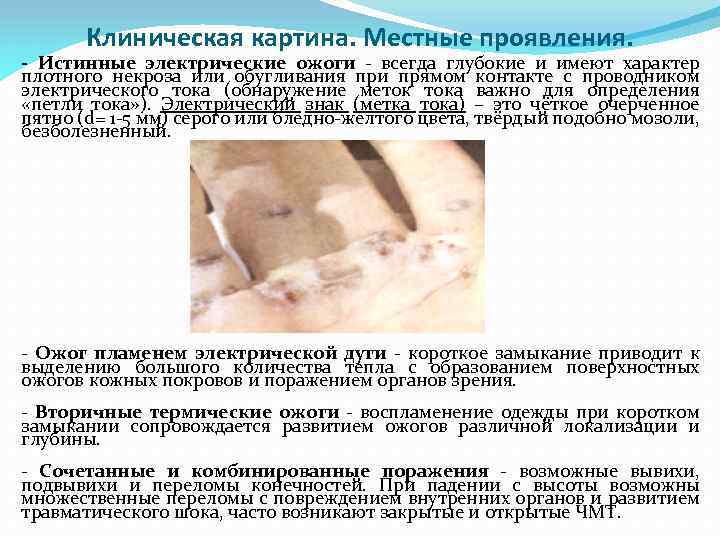 Клиническая картина. Местные проявления. - Истинные электрические ожоги - всегда глубокие и имеют характер