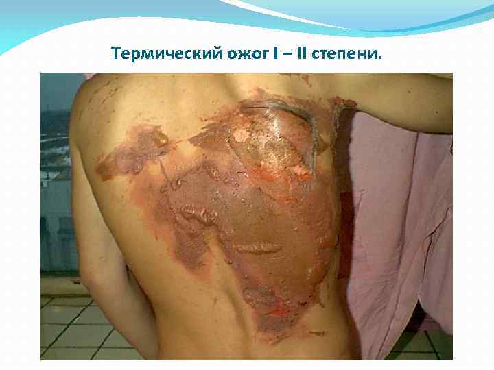 Термический ожог I – II степени. 