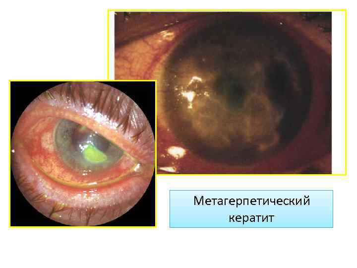 Метагерпетический кератит 