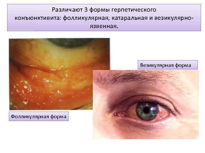 Различают 3 формы герпетического конъюнктивита: фолликулярная, катаральная и везикулярноязвенная. Везикулярная форма Фолликулярная форма 