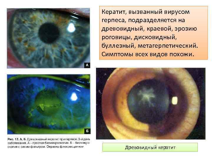 Кератит, вызванный вирусом герпеса, подразделяется на древовидный, краевой, эрозию роговицы, дисковидный, буллезный, метагерпетический. Симптомы