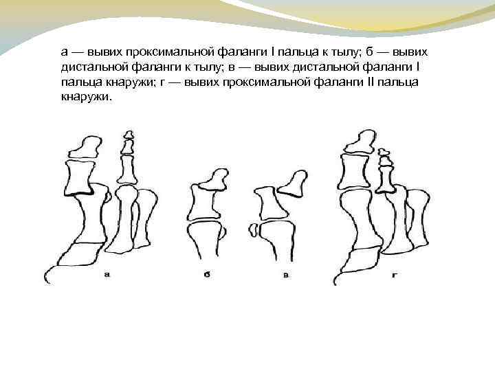 а — вывих проксимальной фаланги I пальца к тылу; б — вывих дистальной фаланги