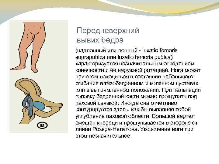 Передневерхний вывих бедра (надлонный или лонный luxatio femoris suprapubica или luxatio femoris pubica) характеризуется