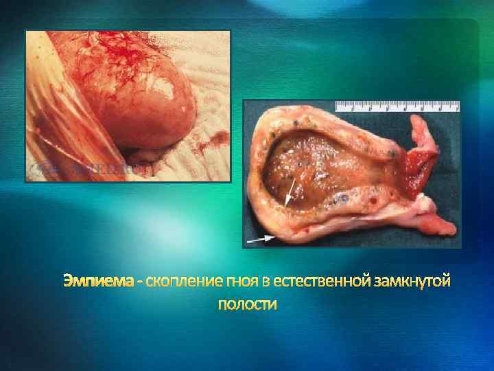 Эмпиема - скопление гноя в естественной замкнутой полости 