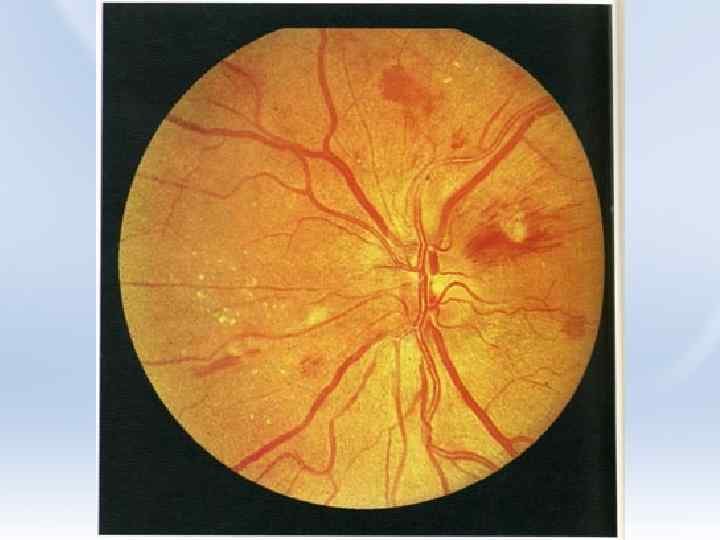 Изменение на глазном дне. Гипертоническая ангиопатия и ретинопатия. Гипертоническая ретинопатия офтальмоскопия. Ангиопатия сетчатки глазное дно. Почечная гипертоническая ретинопатия.