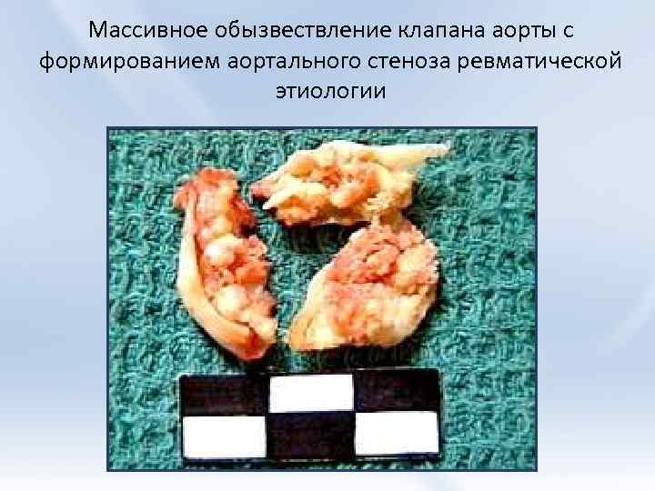 Массивное обызвествление клапана аорты с формированием аортального стеноза ревматической этиологии 