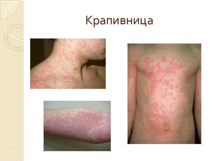 Крапивница 