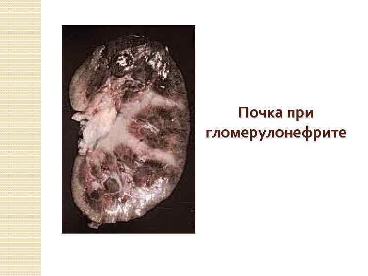 Почка при гломерулонефрите 