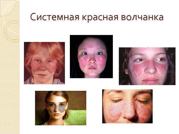 Системная красная волчанка 