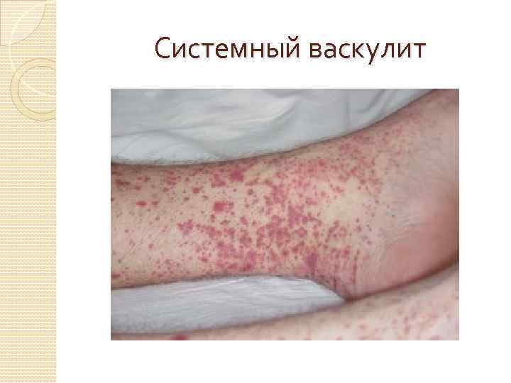 Системный васкулит 