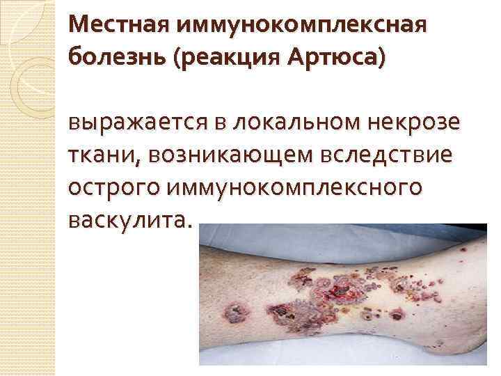 Местная иммунокомплексная болезнь (реакция Артюса) выражается в локальном некрозе ткани, возникающем вследствие острого иммунокомплексного