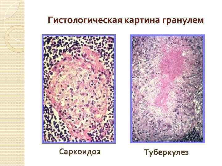 Гистологическая картина гранулем Саркоидоз Туберкулез 