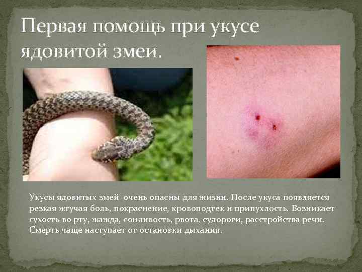 Первая помощь при укусе ядовитой змеи. Укусы ядовитых змей очень опасны для жизни. После
