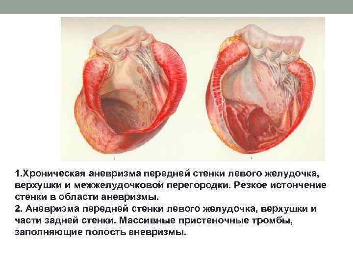 1. Хроническая аневризма передней стенки левого желудочка, верхушки и межжелудочковой перегородки. Резкое истончение стенки