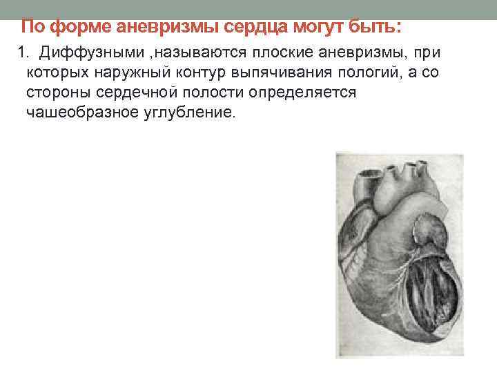 По форме аневризмы сердца могут быть: 1. Диффузными , называются плоские аневризмы, при которых