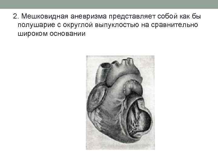 2. Мешковидная аневризма представляет собой как бы полушарие с округлой выпуклостью на сравнительно широком