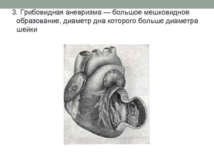 3. Грибовидная аневризма — большое мешковидное образование, диаметр дна которого больше диаметра шейки 