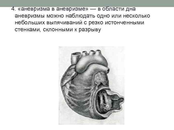 4. «аневризма в аневризме» — в области дна аневризмы можно наблюдать одно или несколько