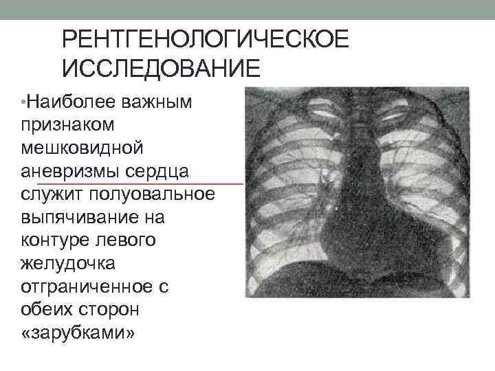 РЕНТГЕНОЛОГИЧЕСКОЕ ИССЛЕДОВАНИЕ • Наиболее важным признаком мешковидной аневризмы сердца служит полуовальное выпячивание на контуре