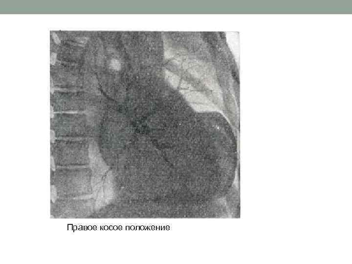 Правое косое положение 