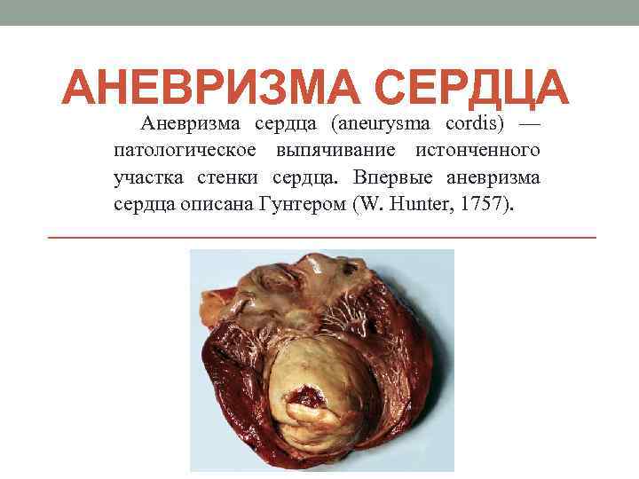 АНЕВРИЗМА СЕРДЦА Аневризма сердца (aneurysma cordis) — патологическое выпячивание истонченного участка стенки сердца. Впервые