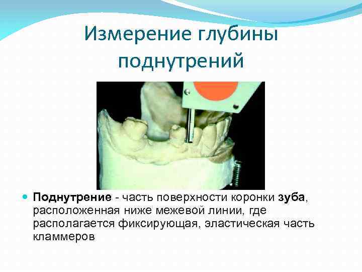 Измерение глубины поднутрений Поднутрение - часть поверхности коронки зуба, расположенная ниже межевой линии, где