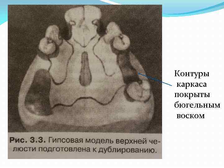 Контуры каркаса покрыты бюгельным воском 
