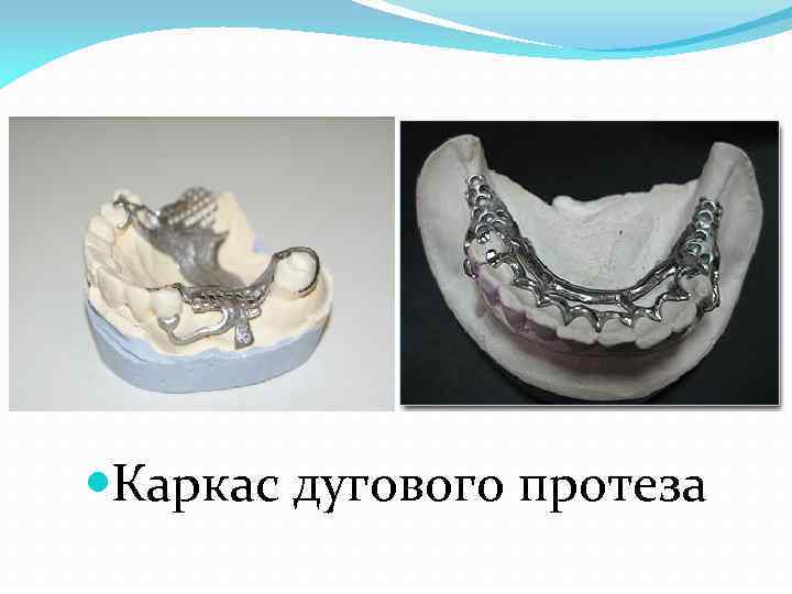  Каркас дугового протеза 
