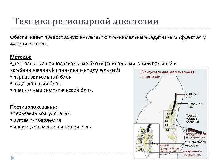 Техника регионарной анестезии Обеспечивает превосходную анальгезию с минимальным седативным эффектом у матери и плода.