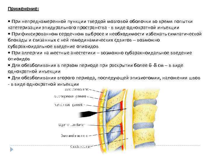 Применение: • При непреднамеренной пункции твердой мозговой оболочки во время попытки катетеризации эпидурального пространства