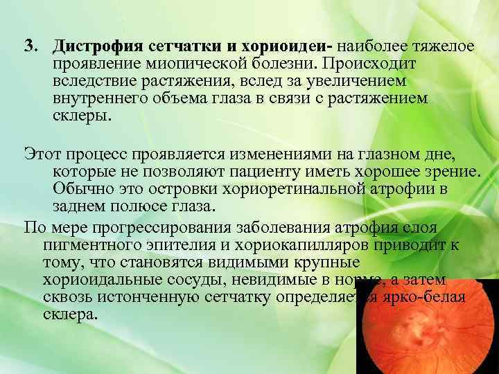3. Дистрофия сетчатки и хориоидеи- наиболее тяжелое проявление миопической болезни. Происходит вследствие растяжения, вслед