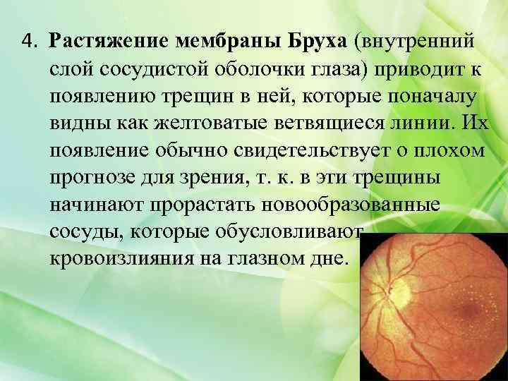 4. Растяжение мембраны Бруха (внутренний слой сосудистой оболочки глаза) приводит к появлению трещин в