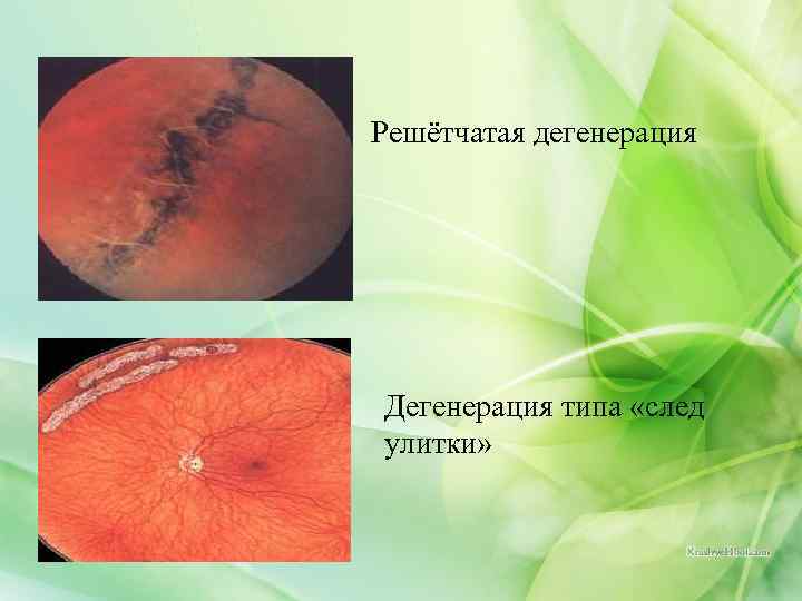 Решётчатая дегенерация Дегенерация типа «след улитки» 