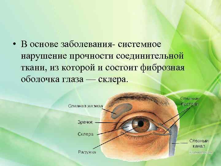  • В основе заболевания- системное нарушение прочности соединительной ткани, из которой и состоит