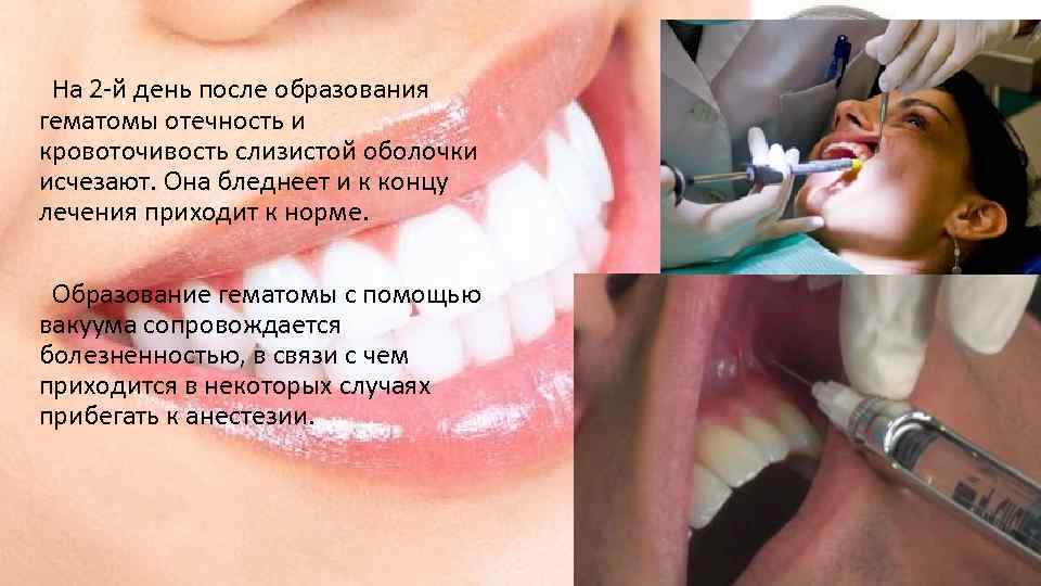 На 2 -й день после образования гематомы отечность и кровоточивость слизистой оболочки исчезают. Она