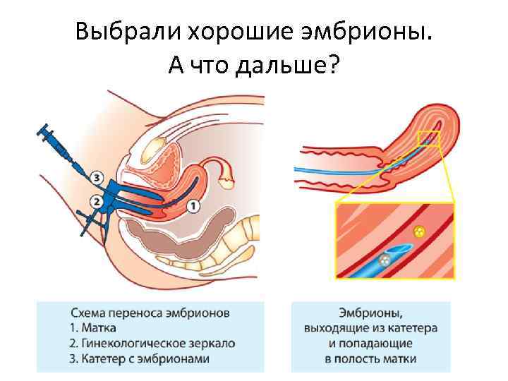 Выбрали хорошие эмбрионы. А что дальше? 